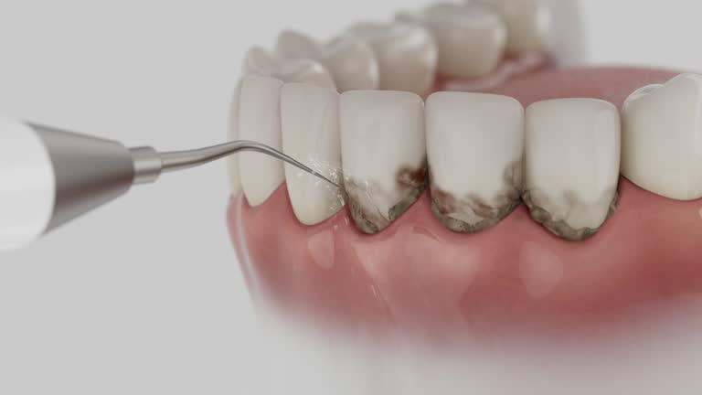 Reliable Tooth Extraction contractor in Meridian, TX by Smile Center Dentistry